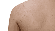 Body Acne Bioderma Help Affiliate