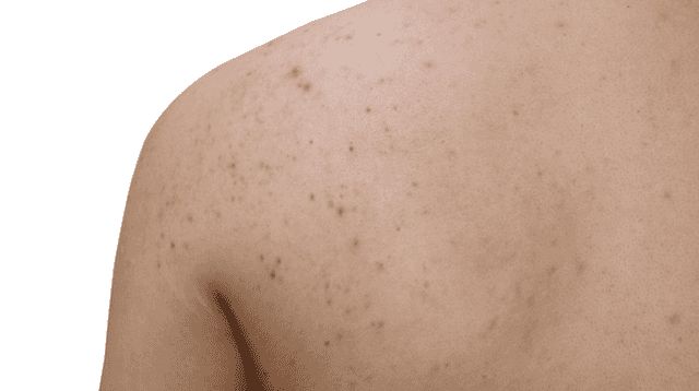 This is the perfect product to use if you suffer from stubborn body acne