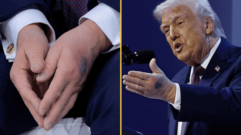 Reason for the bruises on Donald Trump’s hands revealed