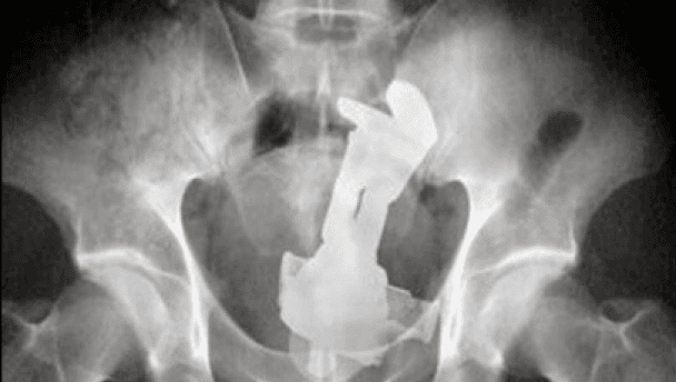 To infinity… and beyond? X-ray shows Buzz Lightyear doll stuck in rear end