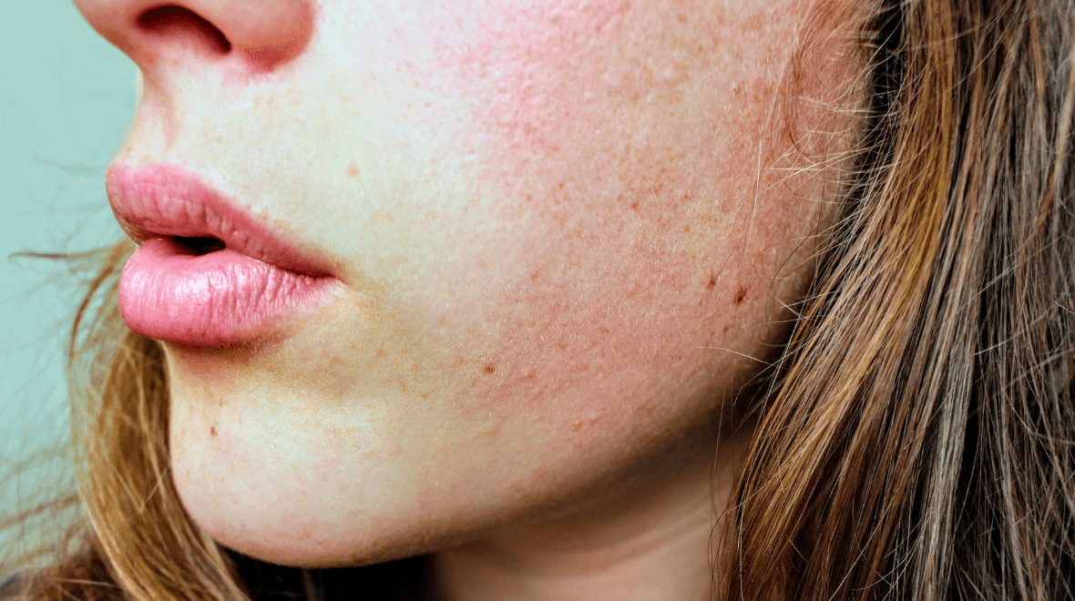 One of the best serums for reducing redness currently has a huge discount