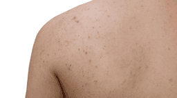 This is the perfect product to use if you suffer from stubborn body acne