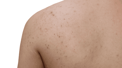 This is the perfect product to use if you suffer from stubborn body acne