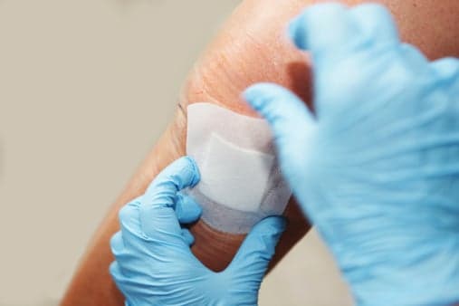 Dissolvable skin cancer patch developed in Belfast aims to ease treatment