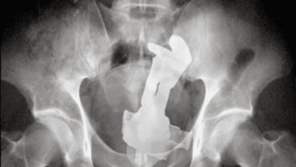 To infinity… and beyond? X-ray shows Buzz Lightyear doll stuck in rear end To infinity… and beyond? X-ray shows Buzz Lightyear doll stuck in rear end