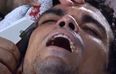 Video: Pepe had a nasty face wound stapled shut on the pitch last night (Warning: Graphic Content)