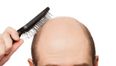 Hair Today Gone Tomorrow: JOE takes a look at receding hairlines and how LLLT technology could help…