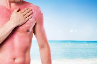 Pic: Apply sun screen to avoid looking like this lad from Donegal