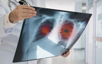 Irish Cancer Society calls for lung cancer screening programme to be introduced