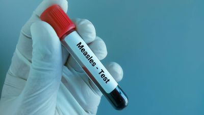 HSE issues urgent warning to passengers on Dublin flight after measles case confirmed